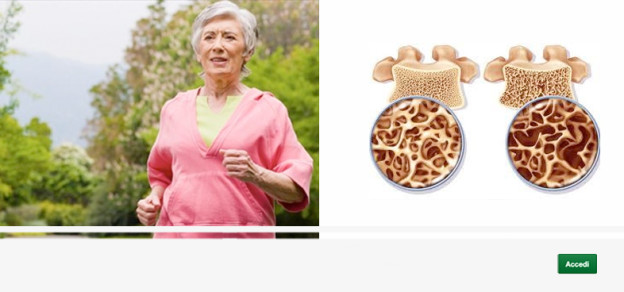 L'osteoporosi, Mineralometria, Ossea, Computerizzata